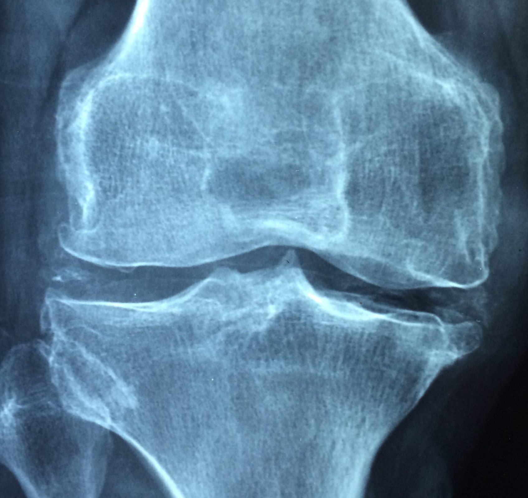 Immagine relativa all'osteoporosi